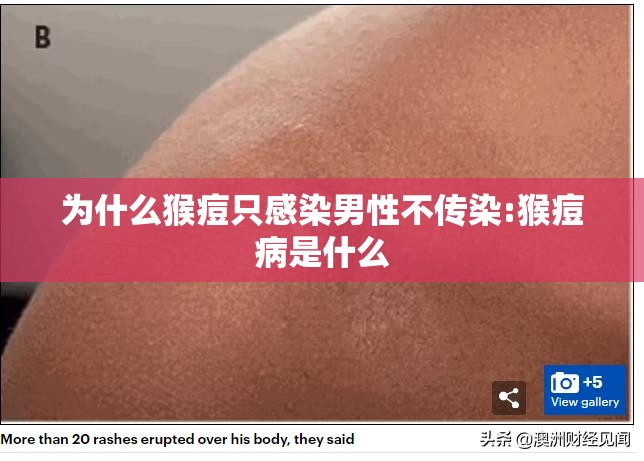 为什么猴痘只感染男性不传染:猴痘病是什么
